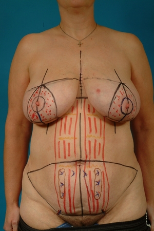 Marks for the mastectomies and TRAM flap breast reconstruction