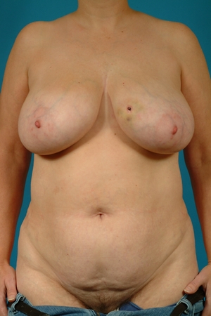Before mastectomies and muscle sparing free TRAM flap breast reconstruction