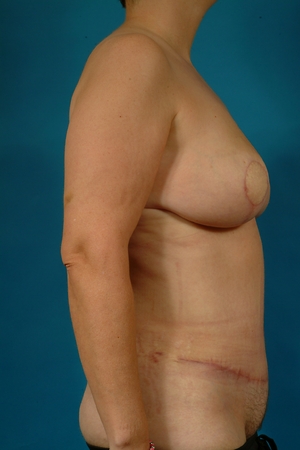 After mastectomies & 1st stage breast reconstruction