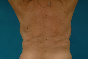 After - Back donor site