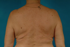 After - Back donor site
