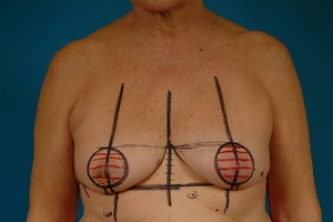 Before; 1st stage markings