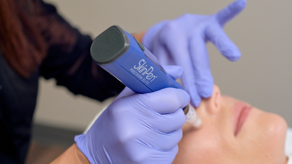 Why SkinPen® Fits Into Your Routine Throughout the Year